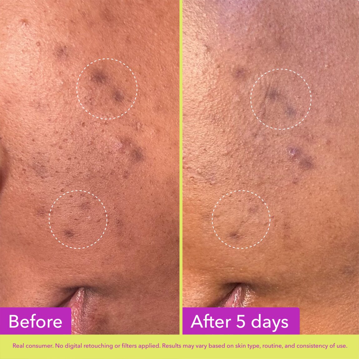 dark-spot-microdart-patches-j0 zb_p.jpg