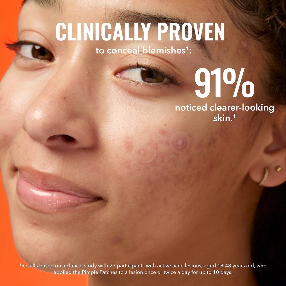 pimple-patches-j1 zb_p.jpg